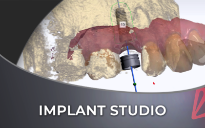 3Shape Implant Studio Workflow