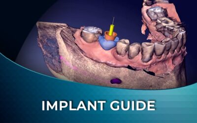 DIW 03 Single Tooth Implant Digital Workflow