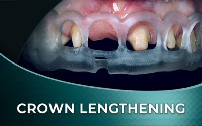 Digitally Guided Surgical Crown Lengthening + DSD