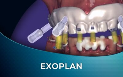 Exoplan – Surgical Guide Designs for Single Units and Full Arches