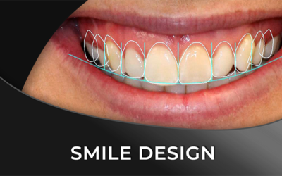 Smile Design Guide – Techniques and Software Comparison