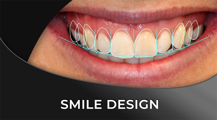 Smile Design Guide – Techniques and Software Comparison